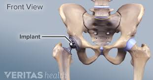 Anterior Vs Posterior Hip Replacement Surgeries Hip Replacement Surgery Total Hip Replacement Hip Replacement