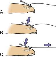 Image result for Fishhook Removal