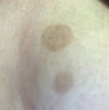 2 Braune Flecke Unter Der Brust Flecken