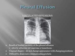 Pleural fluid ldh > two thirds of upper limit for serum ldh. Loculated Pleural Effusion Pleural Effusion Pleural Fluid Ldh Two Thirds Of Upper Limit For Serum Ldh Stewart Hauptman
