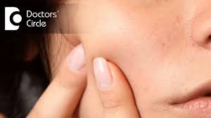 The lateral aspect of the head. What Can Cause Painful Lump On Cheek Dr Srivats Bharadwaj Youtube