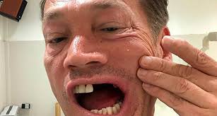 The ricky butcher actor had suffered the horror accident while he was on a. Golfer Requires 15 Hours Of Facial Reconstruction Surgery Swingu Clubhouse