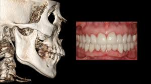 Image result for Occlusal