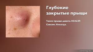Kak Vydavit Prysh Kotoryj Ne Vydavlivaetsya Kak Pravilno Vydavlivat Pryshi I Kakie Sovety Kosmetologa Po Udaleniyu Pryshej V Domashnih Usloviyah Kak Vydavit Prysh Esli Net Instrumenta Pod Rukoj