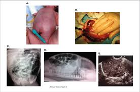 Image result for Necrotizing Enterocolitis