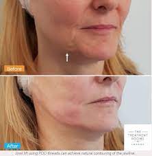 Maybe you would like to learn more about one of these? Jowl Thread Lift What You Need To Know The Treatment Rooms London