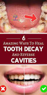 How To Heal Tooth Decay And Reverse Cavities Naturally Tooth Decay Remedies Heal Cavities Cure Tooth Decay