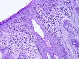 The visual symptoms of lentigo maligna melanoma are very similar to those of lentigo maligna. Pathology Outlines Invasive Melanoma