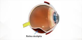 Dezlipirea de retina este sugerata de simptomatologie si examenul fundului de ochi. Dezlipirea De RetinÄ Q Vision