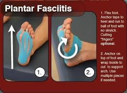 How To Treat Plantar Fasciitis Including Taping And Exercises Kinesiology Taping Plantar Fasciitis Taping Plantar Fasciitis