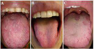 Anxiety And Salivary Level Of Alpha Amylase In Patients With Geographic Tongue A Case Control Study Fulltext