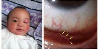 Maybe you would like to learn more about one of these? Cacing Dalam Mata Anak Sebab Tak Basuh Tangan Lepas Keluar Tandas