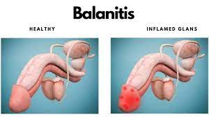 Balanitis Causes | Symptoms | Treatments | Complications