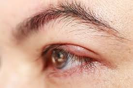 Black tea bag for stye. Eye Doctors 4 Remedies For A Stye