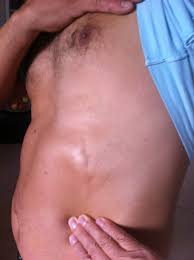 Pouchot j, sampalis js, beaudet f, et al. Bodybuilding Induced Mondor S Disease Of The Chest Wall Sciencedirect
