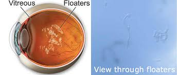 Image result for Floaters