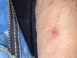 Filled with pus and accidentally popped it. Bump On Penis Help Penis Disorders Forums Patient