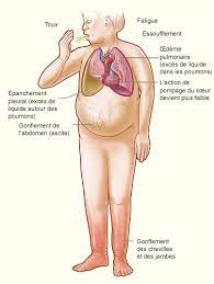 Une insuffisance cardiaque congestive (icc) survient lorsque le cœur ne peut plus pomper le sang symptômes et complications. Insuffisance Cardiaque Chez L Humain Wikipedia