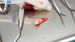 Image result for Tooth Avulsion