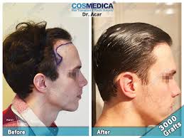 5 star hotel, transfers, tours natural clinic turkey is best for hair transplants and hair loss treatments. Hair Transplant Turkey Istanbul Dr Levent Acar