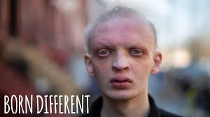 Modelling Helped Me Embrace My Rare Condition