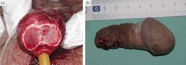 A case of penile self‐mutilation during a suicidal attempt successfully  treated using a multidisciplinary approach - Nagoshi - 2022 - IJU Case  Reports - Wiley Online Library