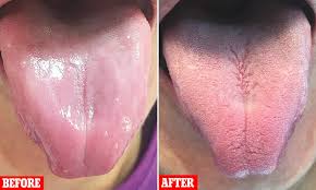 Cutting off swollen taste buds. Pensioner S Taste Buds Disappear Due To A Blood Condition Daily Mail Online