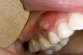 Gum Boils: What They Are And How To Treat Them