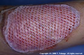 Image result for Pathergy