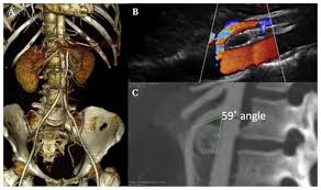 If you or someone you. Combined Nutcracker And Ehlers Danlos Syndromes A Case Report Ejves Vascular Forum