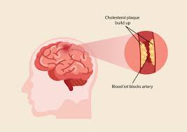 What are the symptoms of brain stroke? What Is Stroke Causes Symptoms Sims Hospital