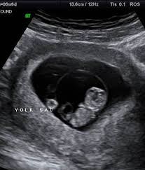 Hi,i am 7 week 4 days pregnant and got my first abdominal scan done.report shows mean sac 17 mm,yolk sac but no fetal pole or heartbeat.apart from that small subchorionic bleed measuring 7*6 mm seen. Kidsbabiesmothers S Blog Just Another Wordpress Com Site