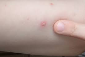 Chicken Pox Symptoms And How To Treat The Condition