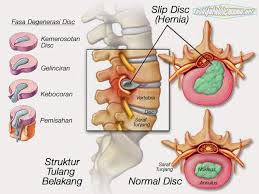 Walaupun ijazah bersekutu dianggap lebih tinggi daripada diploma sekolah tinggi, ia dianggap kurang daripada ijazah sarjana muda. Perlukan Rawatan Fisioterapi Physiomobilemy Sedia Membantu