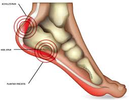 Ligaments connect bone to bone to provide stability of the joints. Heel Pain