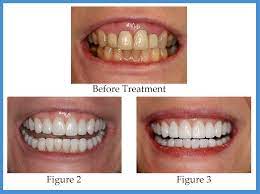 Dental veneers used to last longer than they do now. How Long Does The Porcelain Veneers Process Take Konig Center For Cosmetic Comprehensive Dentistry