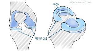 Initial treatment of meniscal tears should be aimed at controlling . Bucket Handle Meniscus Tear Howard J Luks Md