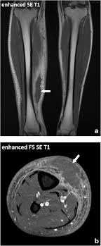 David rubin and robin smithuis. Fasciae Of The Musculoskeletal System Mri Findings In Trauma Infection And Neoplastic Diseases Insights Into Imaging Full Text