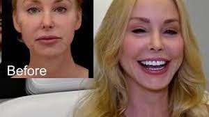 Plastic Surgery Beverly Hills