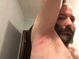 What's the best way to remove a tick safely?