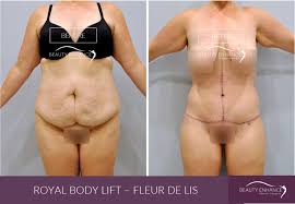 Check out results for pictures tummy tuck Gallery Fleur De Lis Beauty Enhance Plastic Surgery Beauty Enhance