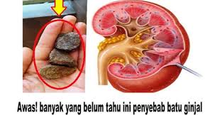 Awas Banyak Yang Belum Tahu Ini Penyebab Batu Ginjal