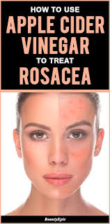 How To Use Apple Cider Vinegar To Treat Rosacea Rosacea Skin Care Warts On Face Rosacea Remedies