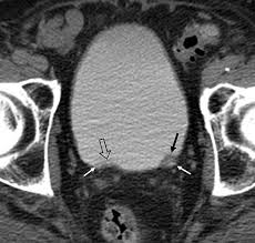 Image result for Helical CT Urogram