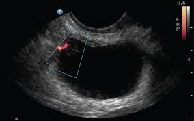 Transitional cell carcinoma (urinary bladder): Clinmed International Library Urinary Incontinence As A Presenting Symptom Of Bladder Cancer Obstetrics And Gynaecology Cases Reviews