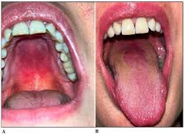 Image result for Oral thrush roof of mouth