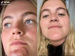 Woman Shows Chin Infection Reportedly Caused By Kissing A Man With Beard  Stubble | The Independent
