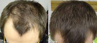 Finasteride has been praised for its lack of side effects throughout the. Pin On Hair Loss