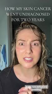 My Skin Cancer Journey: From Diagnosis to Mohs Surgery