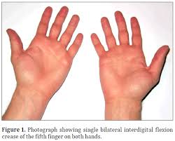 Single palmar crease (simian crease). Single Bilateral Interdigital Flexion Crease Of The Fifth Finger In A Phenotypically Normal Male
